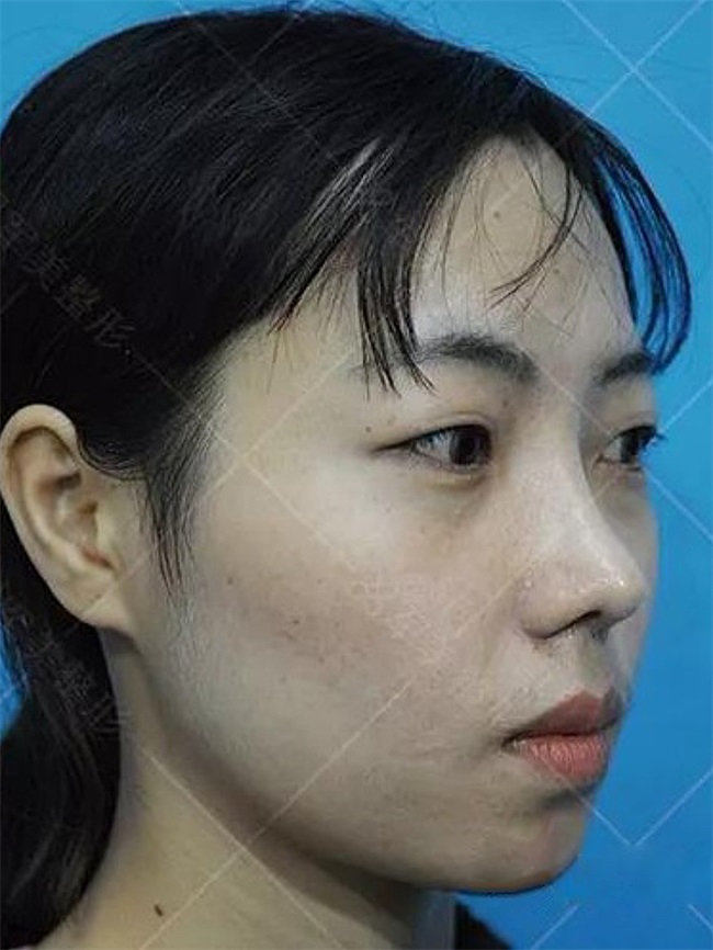 做隆鼻去哪好