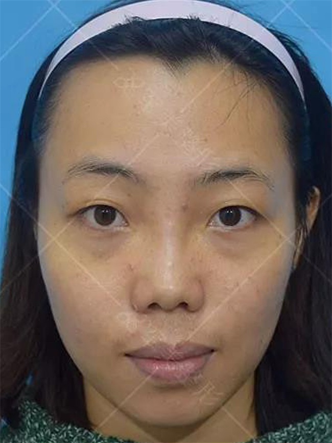 塌鼻子怎么样变挺