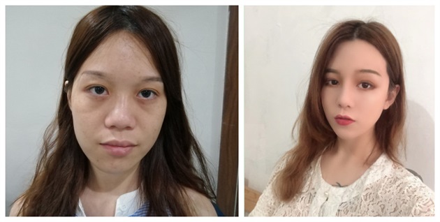 自体脂肪丰脸