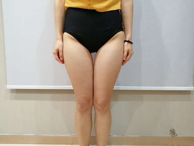 腿部吸脂哪里好