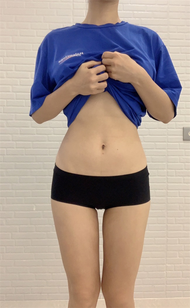 腿部吸脂哪里好