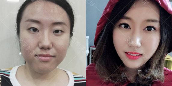 割双眼皮哪里好