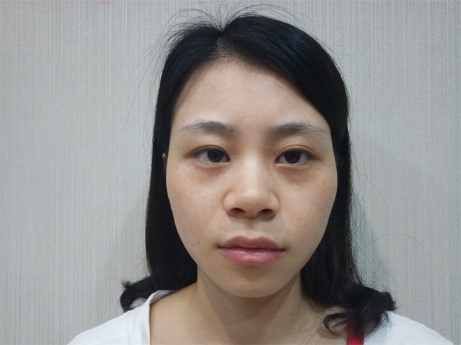 广州做自体脂肪填充的医院哪家好
