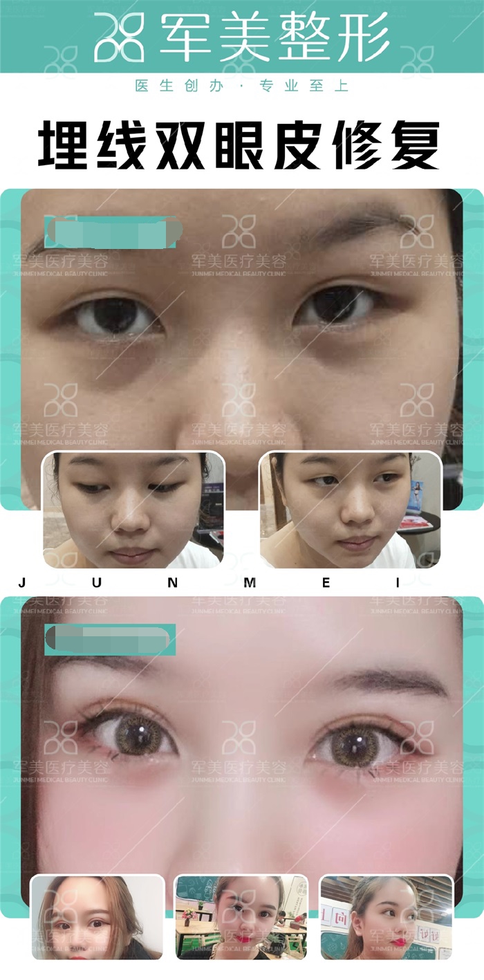 埋线双眼皮修复