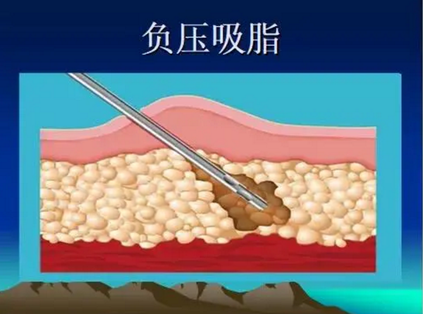 抽脂去哪里好
