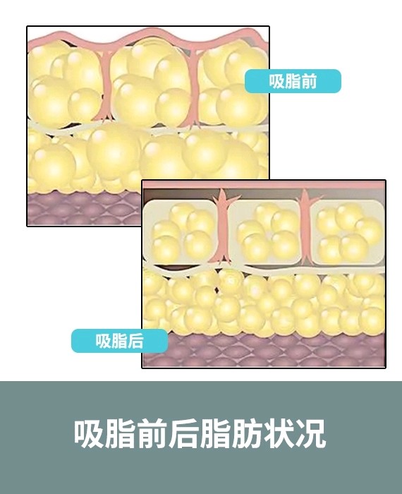吸脂后对比状态