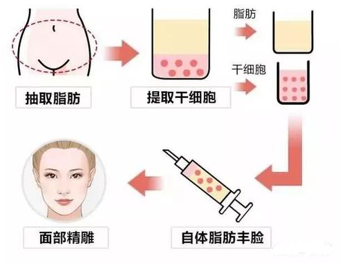 全脸面部脂肪填充