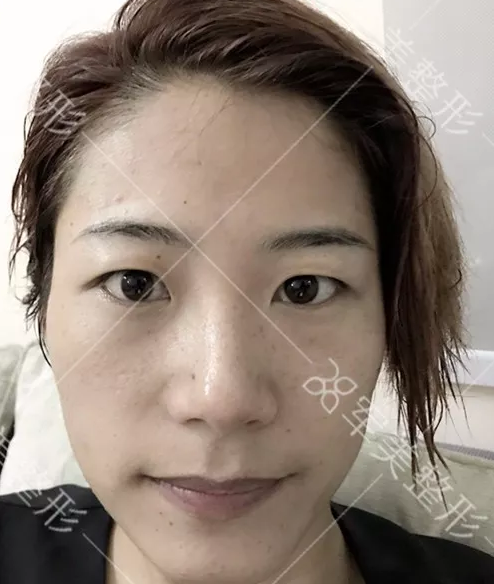 双眼皮整形哪家好