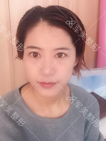 割双眼皮哪里好