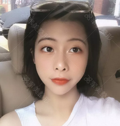 做隆鼻好吗