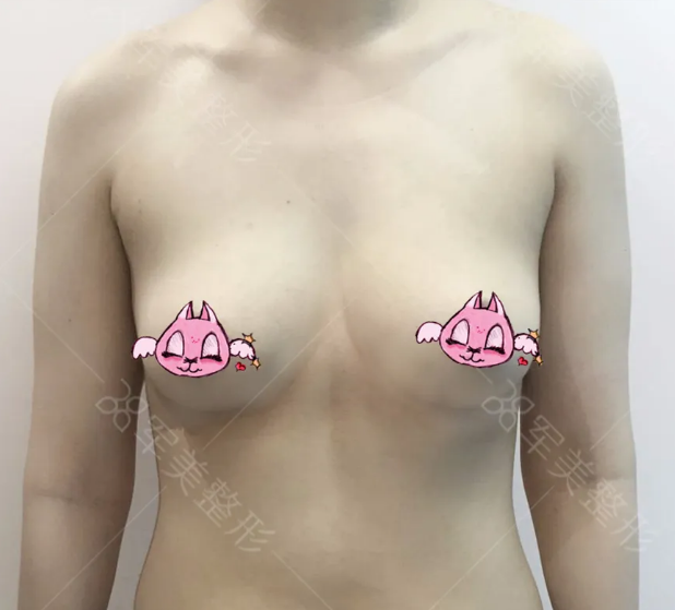 自体脂肪丰胸怎么样
