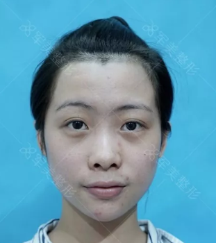 做隆鼻去哪好