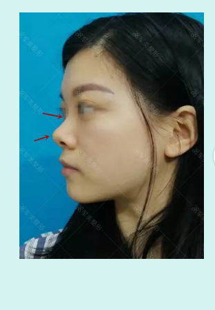 做隆鼻去哪好