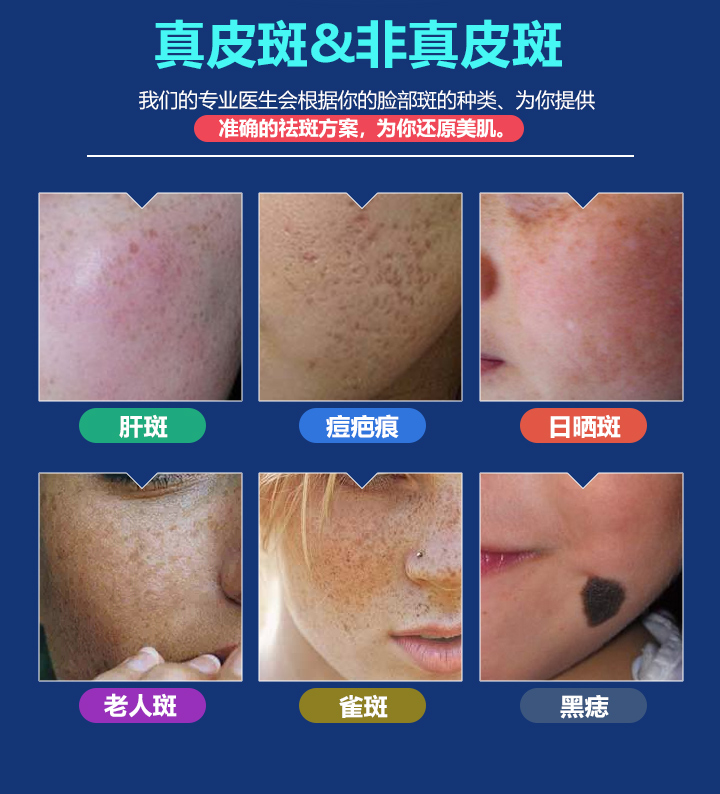 激光祛斑的一般价格