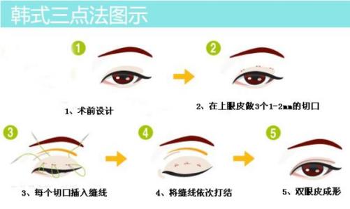 割双眼皮需要多久