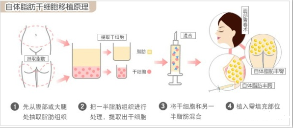 大腿吸脂