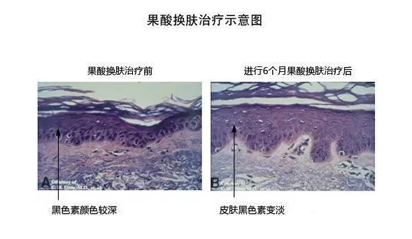 黄褐斑