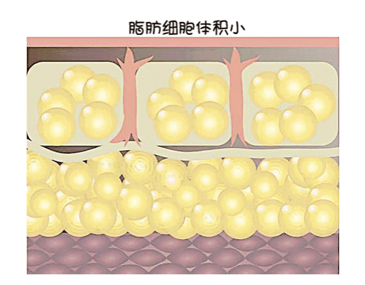 抽脂肪可以减肥吗