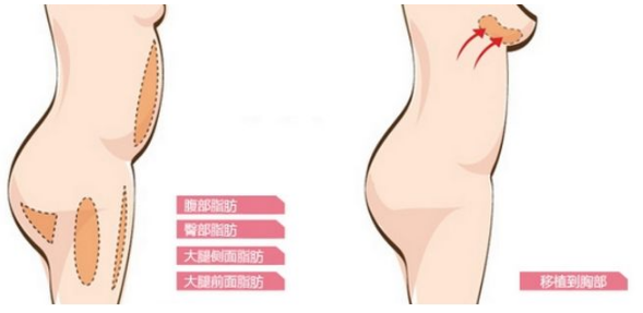 自体脂肪丰胸