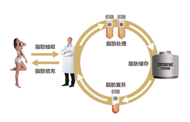 自体脂肪丰胸