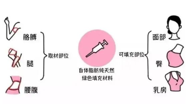 自体脂肪填充后效果