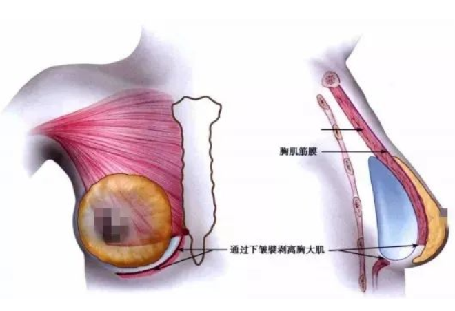假体隆胸多少钱