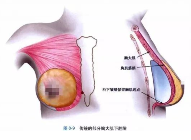 假体隆胸效果