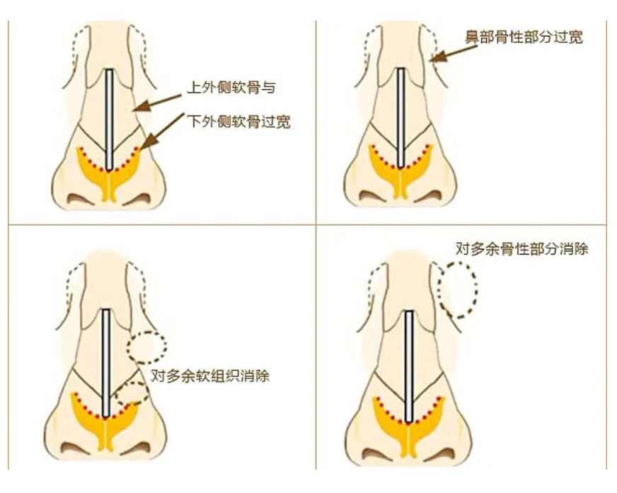 做隆鼻好吗