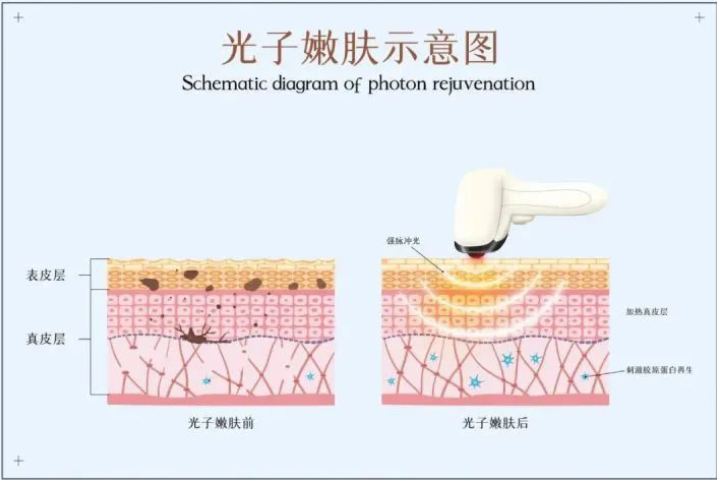 光子嫩肤的功效与作用