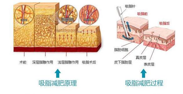 腰腹吸脂对身体有害吗