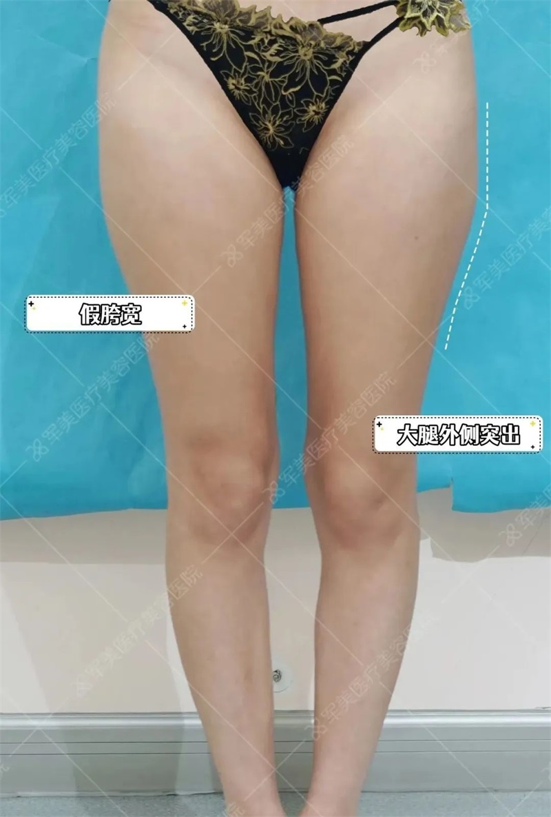 大腿部吸脂减肥