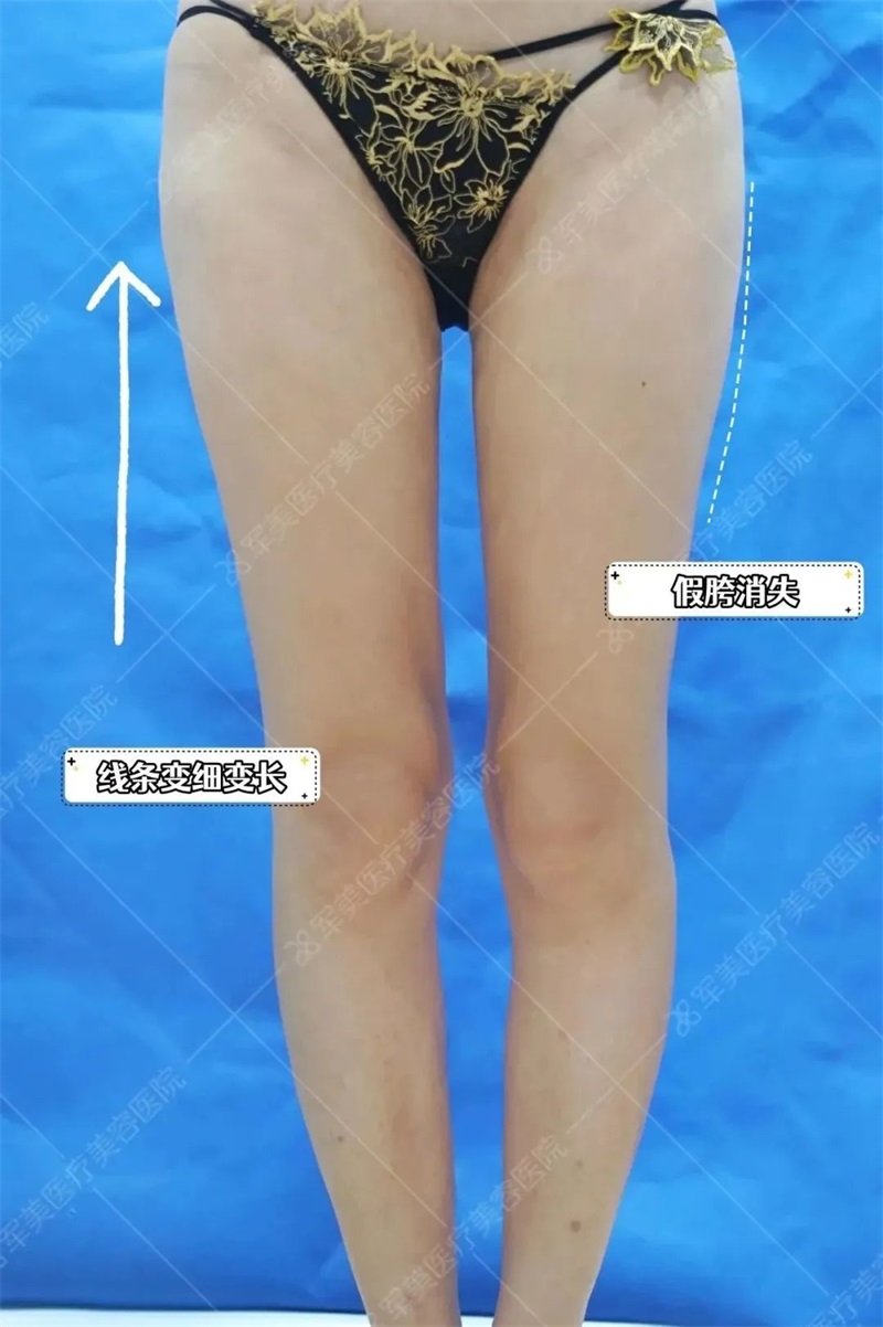 大腿抽脂前后对比真实图片