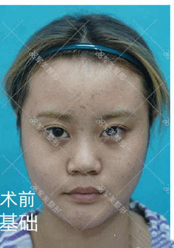 隆鼻手术图片