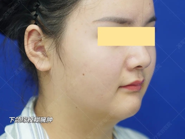 v脸提升可以维持多久