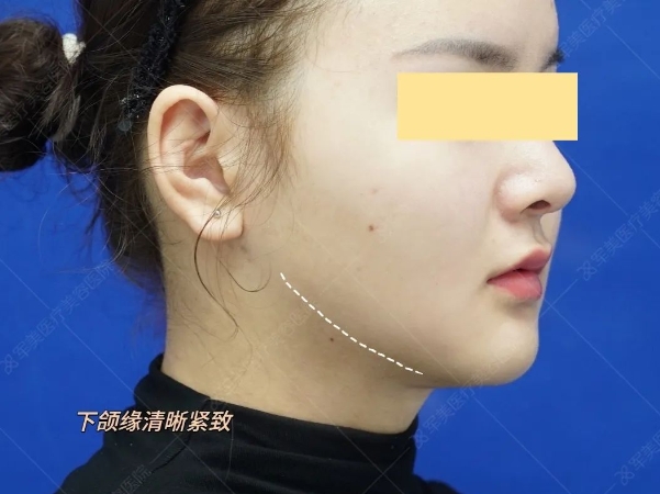v脸提升可以维持多久