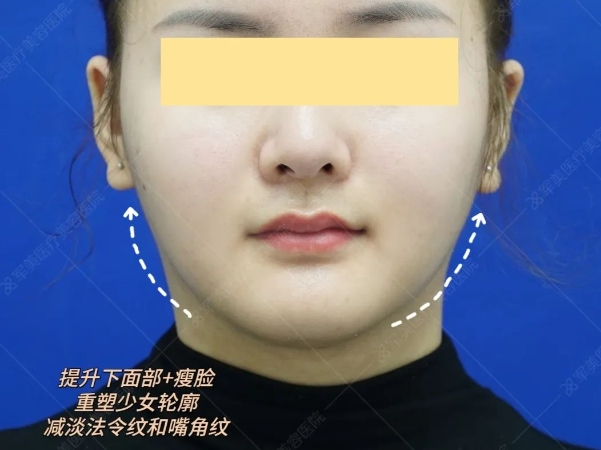 小v脸是怎样整出来的