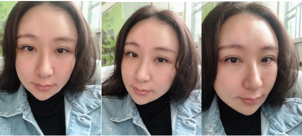 自体脂肪移植案例