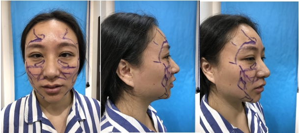 黑眼圈怎么消