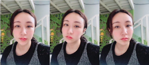 自体脂肪填充面部案例