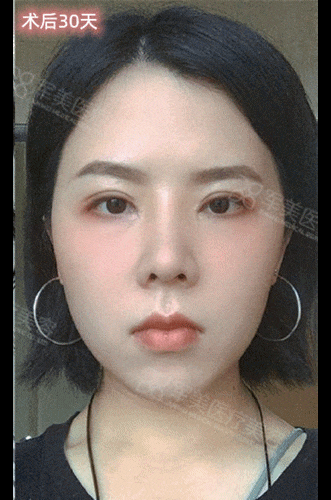 鼻基底凹陷怎么改善