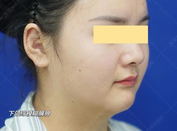 面部筋膜提升多少钱
