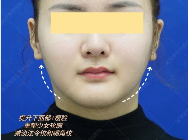 V脸整形
