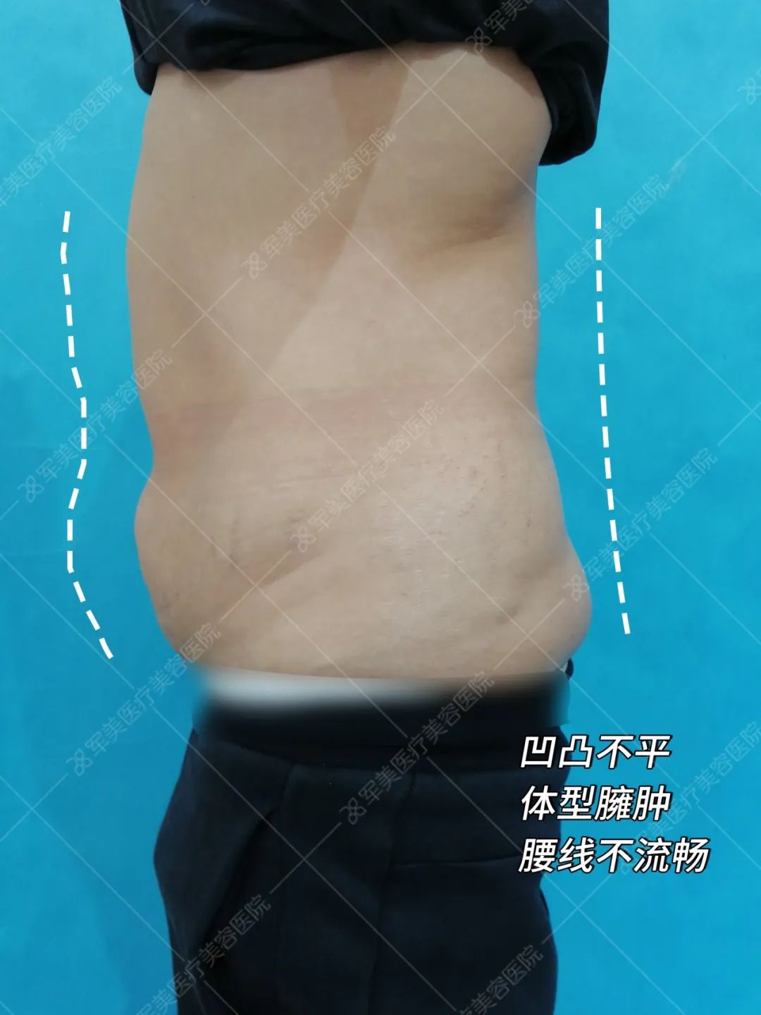 产后腰腹部赘肉怎么瘦