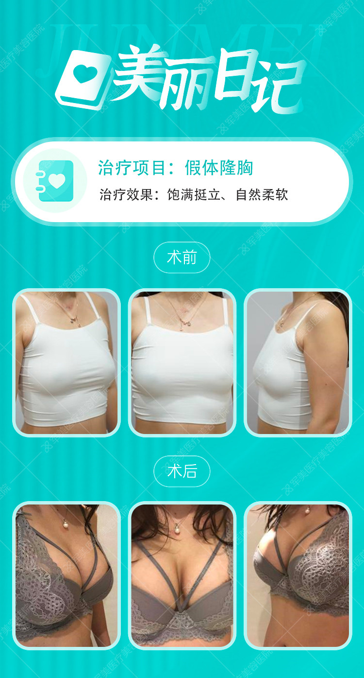 假体隆胸的价格表