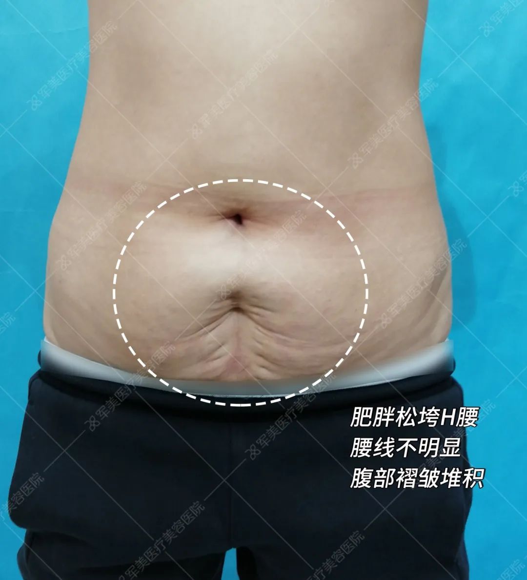 产后腰腹部赘肉怎么减