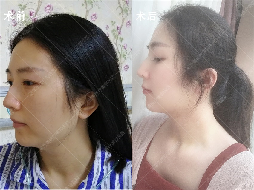 面部吸脂术后效果对比图