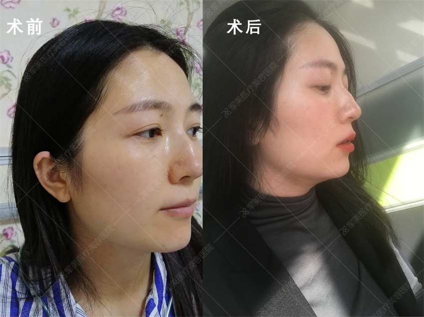 面部吸脂术后效果对比图