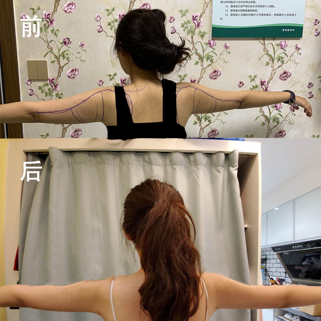 上臂吸脂多少钱