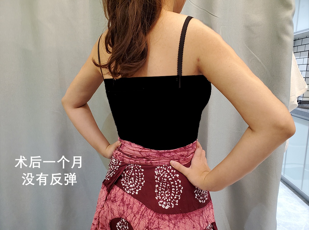 手臂吸脂多久消肿