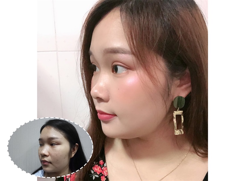 术后五个月_看图王.jpg
